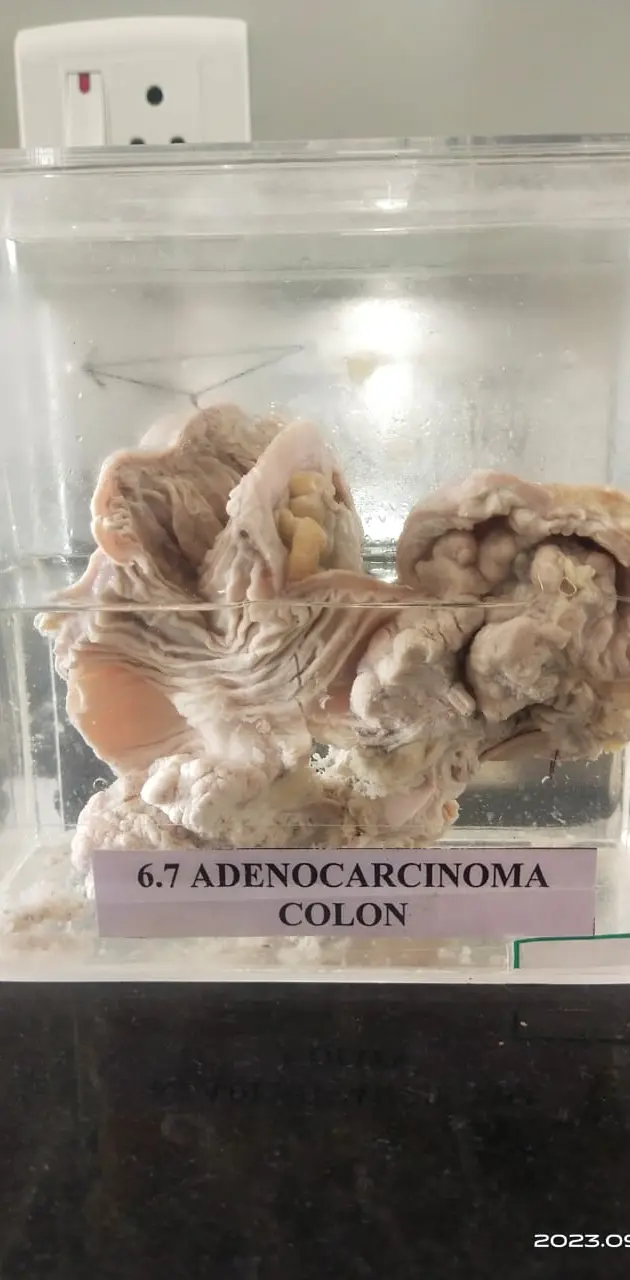Adenocarcinoma of col