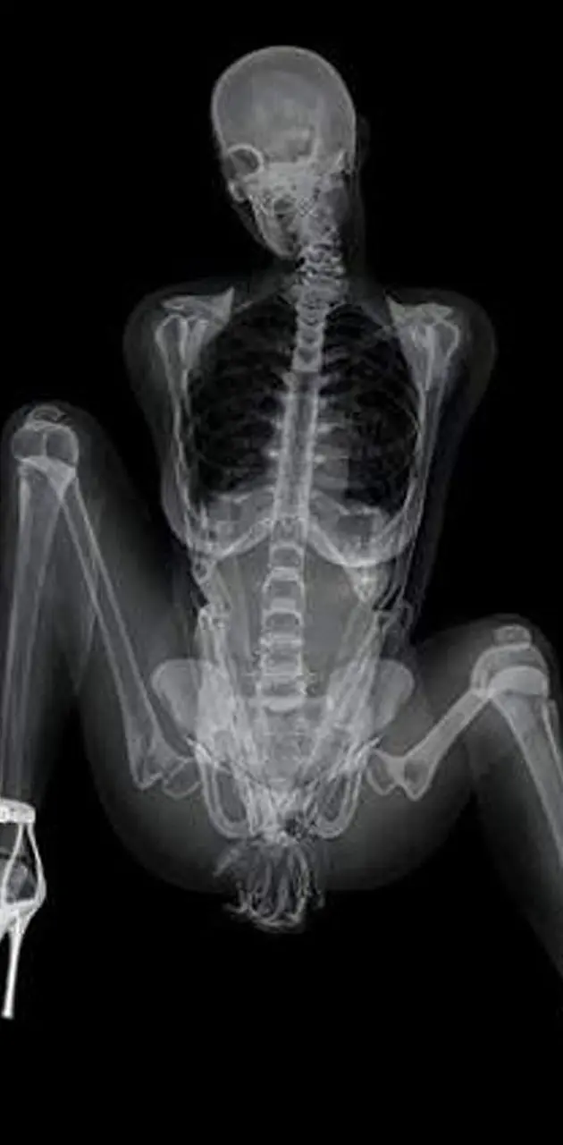 X ray